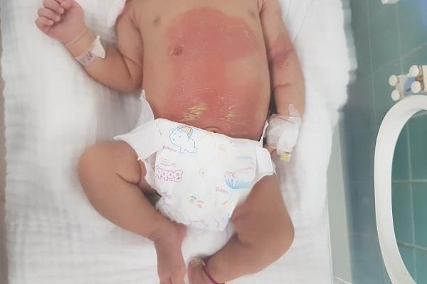 Bé sơ sinh bị bỏng da vì gia đình chữa chướng bụng bằng lá trầu