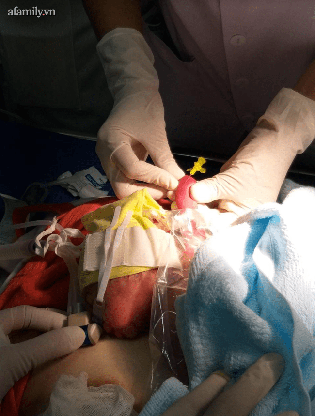 Bé gái Long An sinh “cực non” chỉ nặng 700gram, được bác sĩ cứu sống ngoạn mục