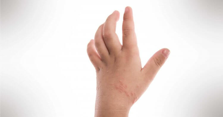 Bệnh chàm ở trẻ em: Các biện pháp khắc phục tự nhiên cho tình trạng da phổ biến này